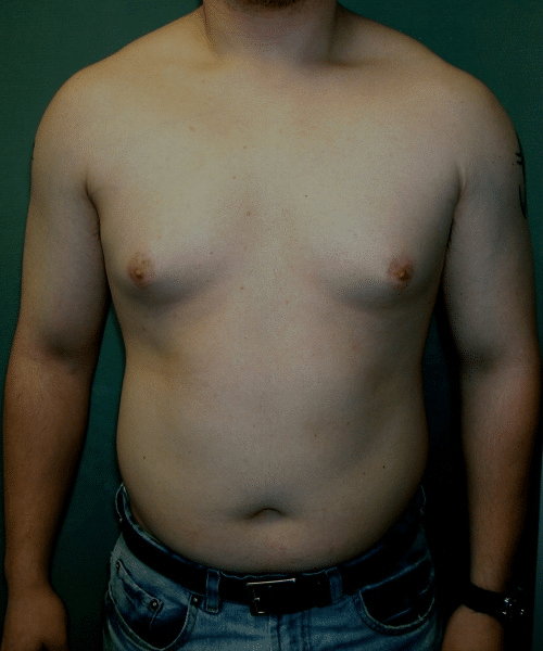 Adults (20-40) Before Photo Adults (20-40)