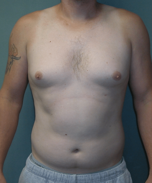 Adults (20-40) Before Photo Adults (20-40)