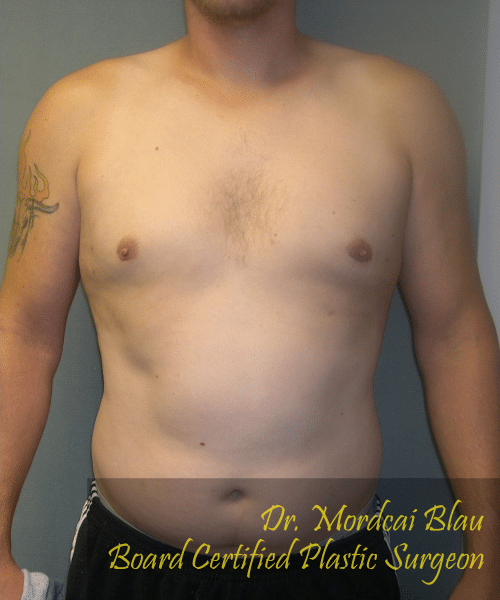 Adults (20-40) After Photo Adults (20-40)