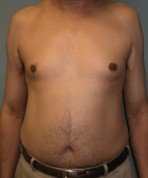 Adults (20-40) Before Photo Adults (20-40)