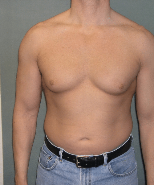 Adults (20-40) Before Photo Adults (20-40)