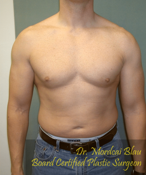 Adults (20-40) After Photo Adults (20-40)