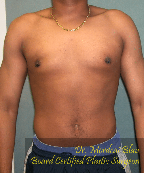 Adults (20-40) After Photo Adults (20-40)