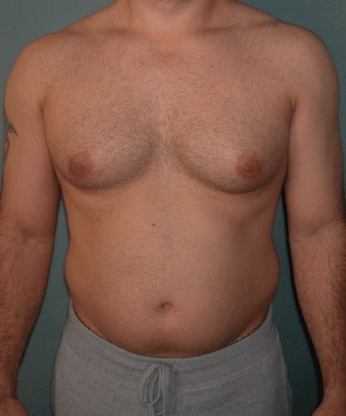 Adults (20-40) Before Photo Adults (20-40)