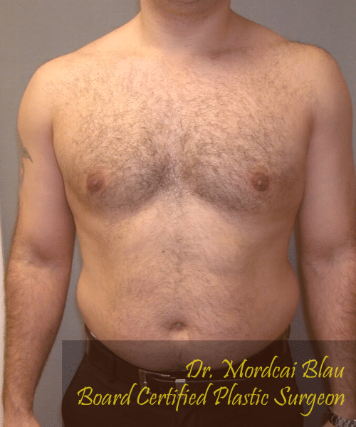 Adults (20-40) After Photo Adults (20-40)