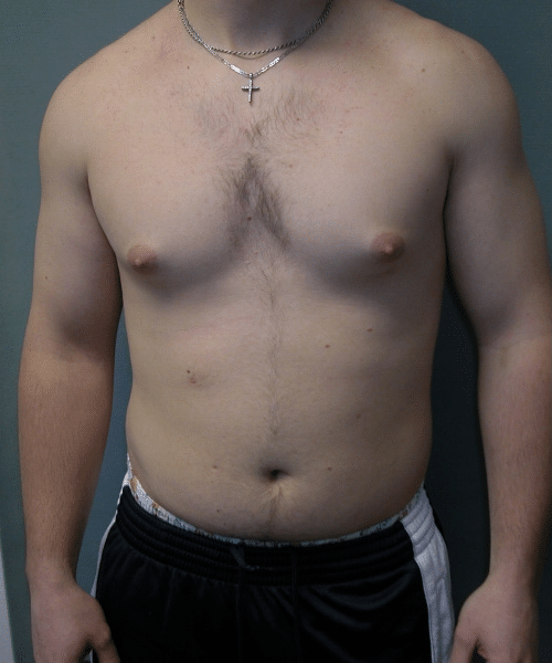 Adults (20-40) Before Photo Adults (20-40)