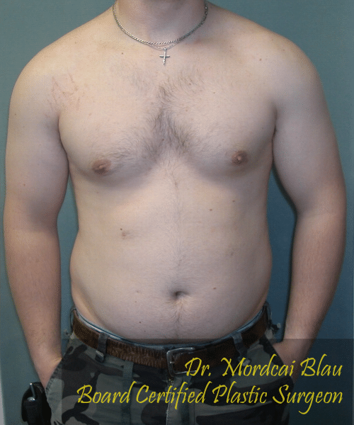 Adults (20-40) After Photo Adults (20-40)