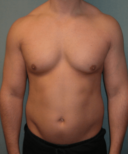 Adults (20-40) Before Photo Adults (20-40)