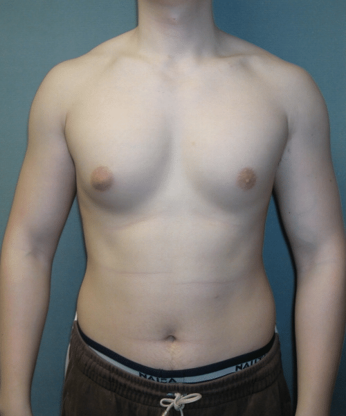 Adults (20-40) Before Photo Adults (20-40)