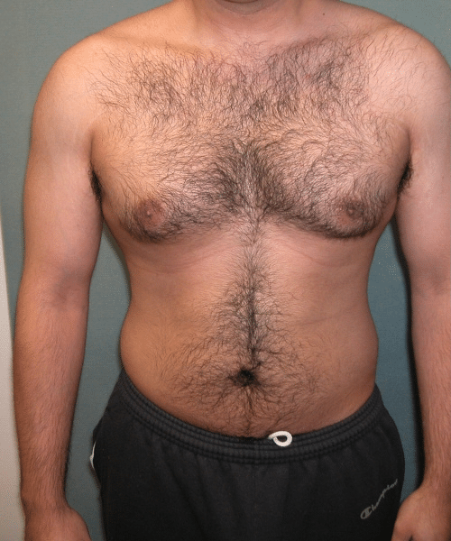 Adults (20-40) Before Photo Adults (20-40)