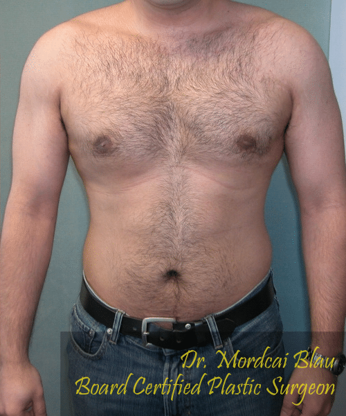 Adults (20-40) After Photo Adults (20-40)