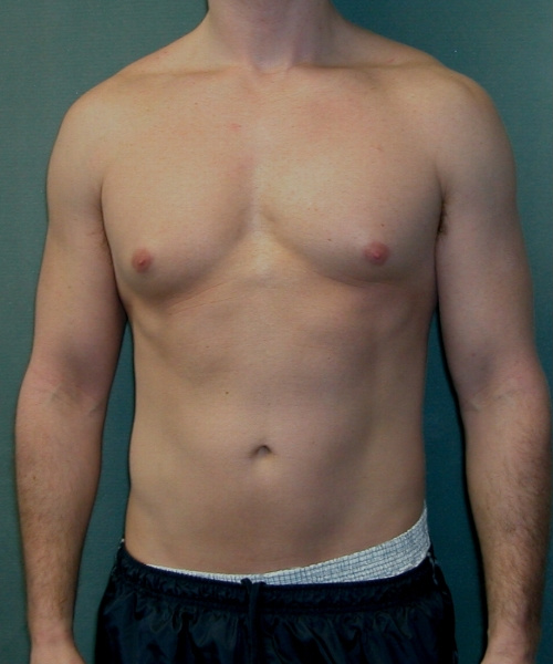 Adults (20-40) Before Photo Adults (20-40)