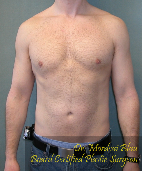 Adults (20-40) After Photo Adults (20-40)