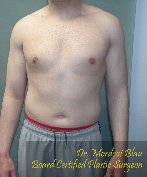 Adults (20-40) After Photo Adults (20-40)