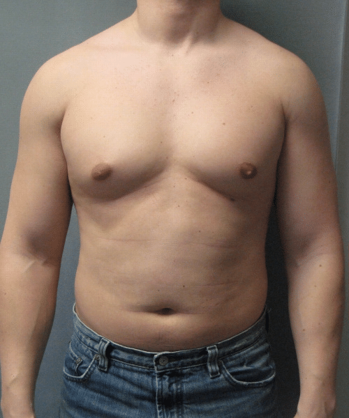 Adults (20-40) Before Photo Adults (20-40)