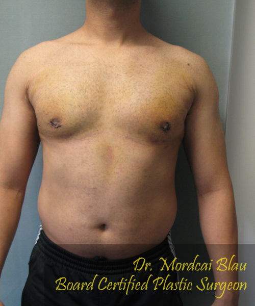 Adults (20-40) After Photo Adults (20-40)