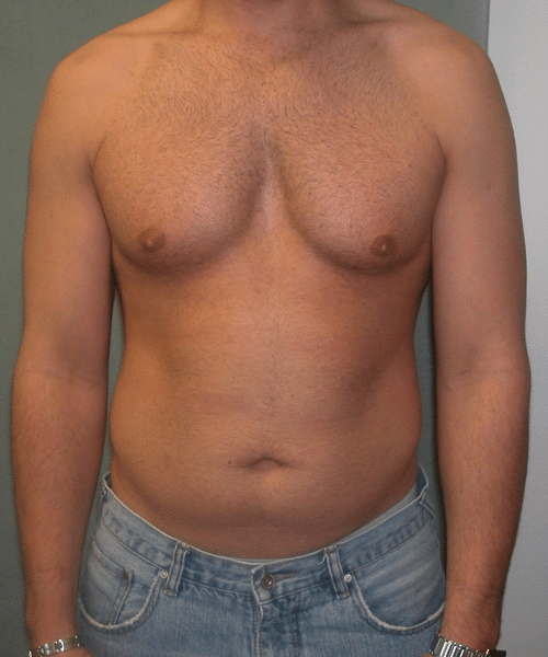 Adults (20-40) Before Photo Adults (20-40)
