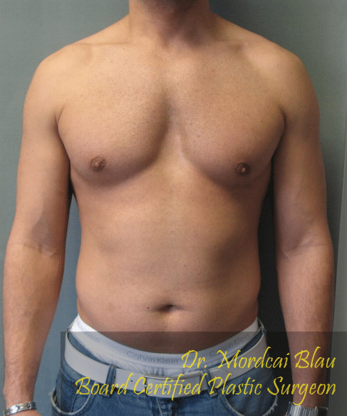 Adults (20-40) After Photo Adults (20-40)