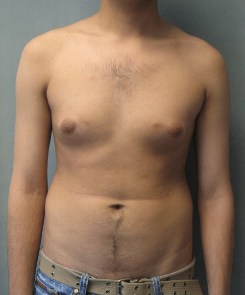 Adults (20-40) Before Photo Adults (20-40)