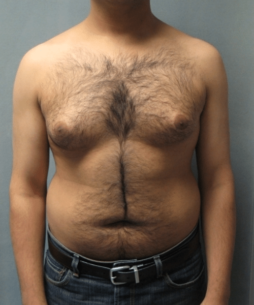 Adults (20-40) Before Photo Adults (20-40)