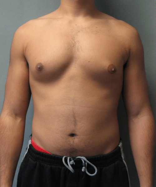 Adults (20-40) Before Photo Adults (20-40)