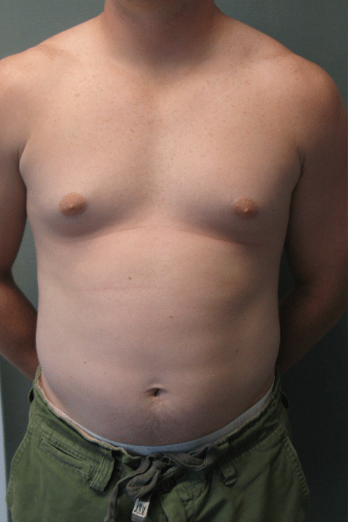 Adults (20-40) Before Photo Adults (20-40)