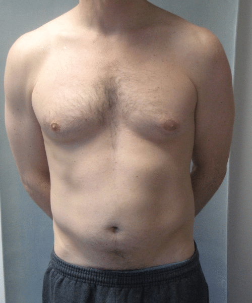 Adults (20-40) Before Photo Adults (20-40)