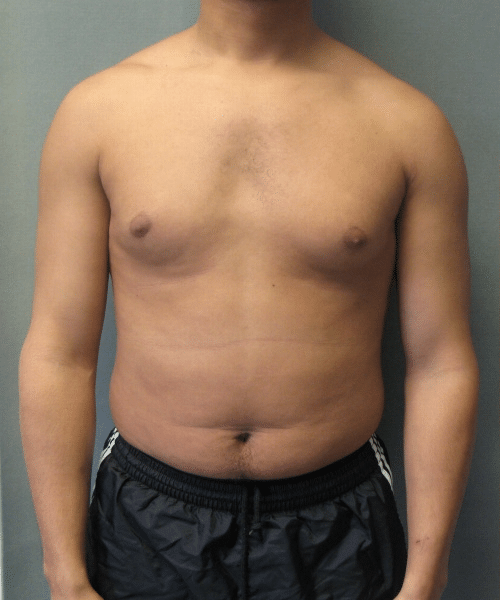 Adults (20-40) Before Photo Adults (20-40)