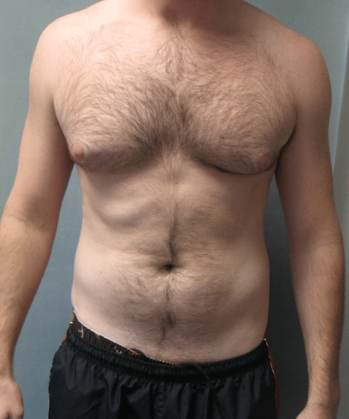 Adults (20-40) Before Photo Adults (20-40)