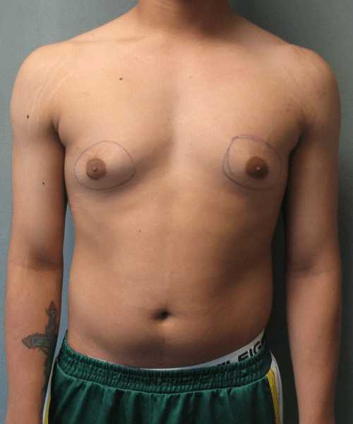 Adults (20-40) Before Photo Adults (20-40)