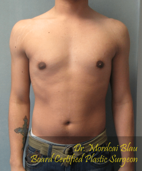 Adults (20-40) After Photo Adults (20-40)