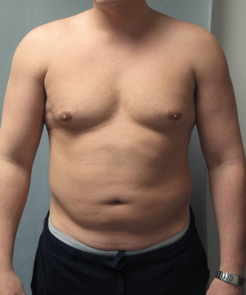 Adults (20-40) Before Photo Adults (20-40)