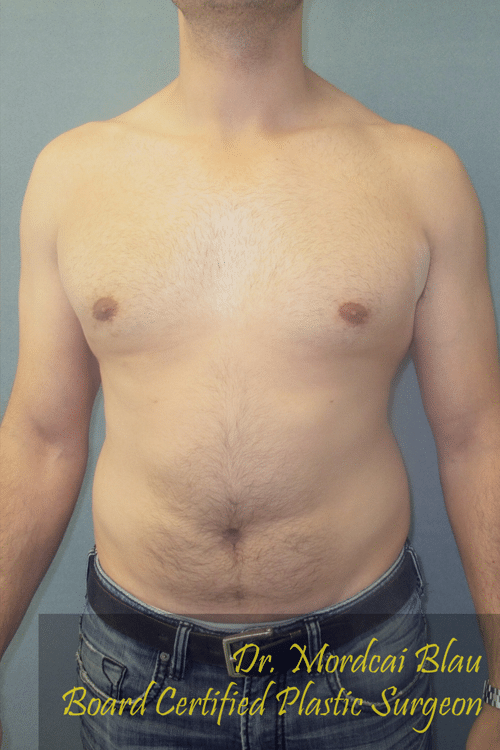 Adults (20-40) After Photo Adults (20-40)