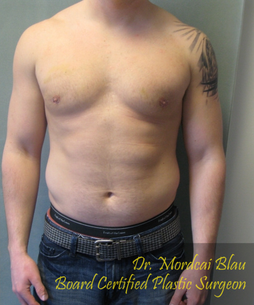 Adults (20-40) After Photo Adults (20-40)