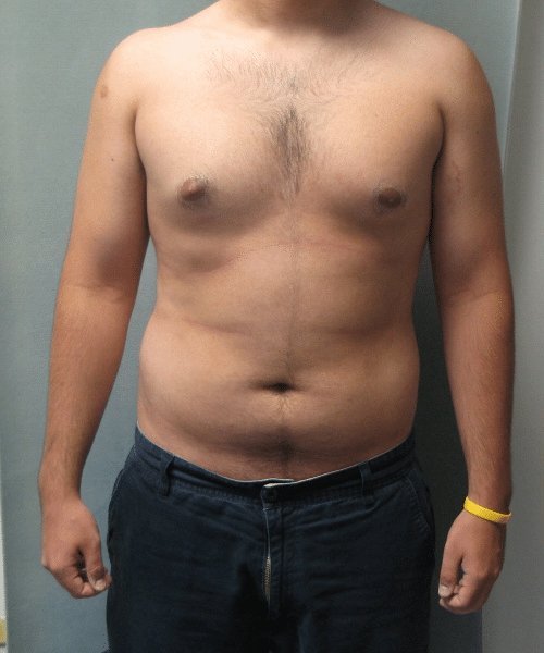 Adults (20-40) Before Photo Adults (20-40)