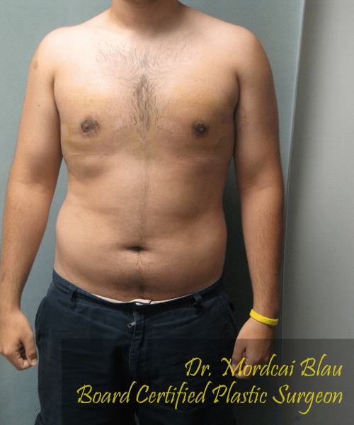 Adults (20-40) After Photo Adults (20-40)