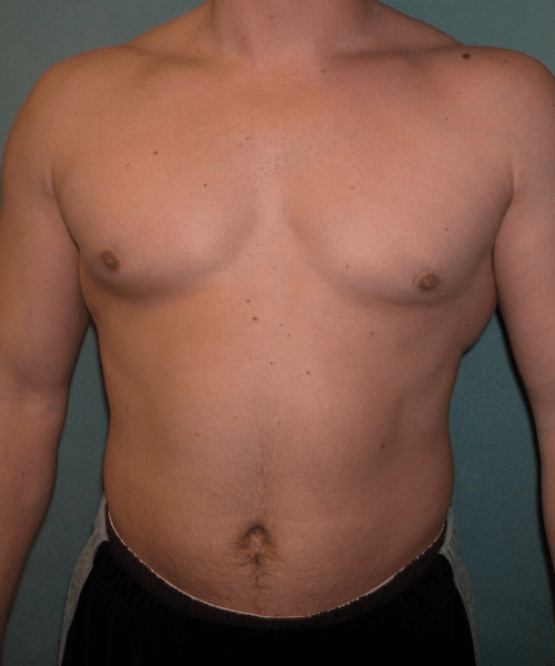Adults (20-40) Before Photo Adults (20-40)