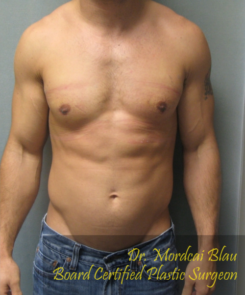 Adults (20-40) After Photo Adults (20-40)