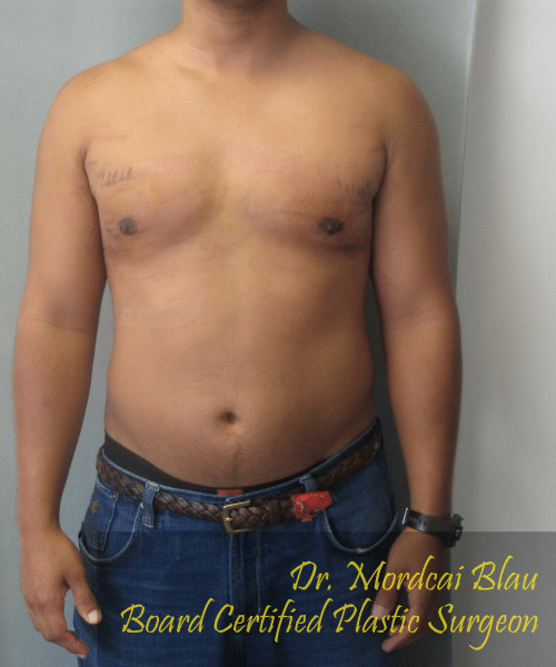 Adults (20-40) After Photo Adults (20-40)
