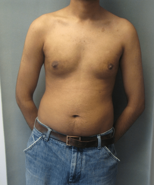 Adults (20-40) Before Photo Adults (20-40)