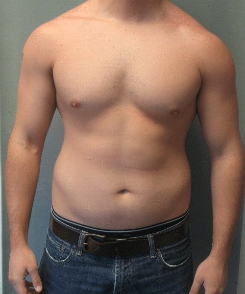 Adults (20-40) Before Photo Adults (20-40)