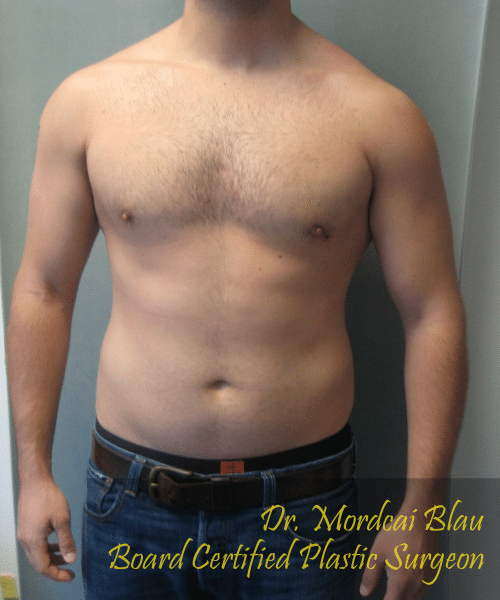 Adults (20-40) After Photo Adults (20-40)