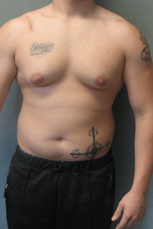 Adults (20-40) Before Photo Adults (20-40)