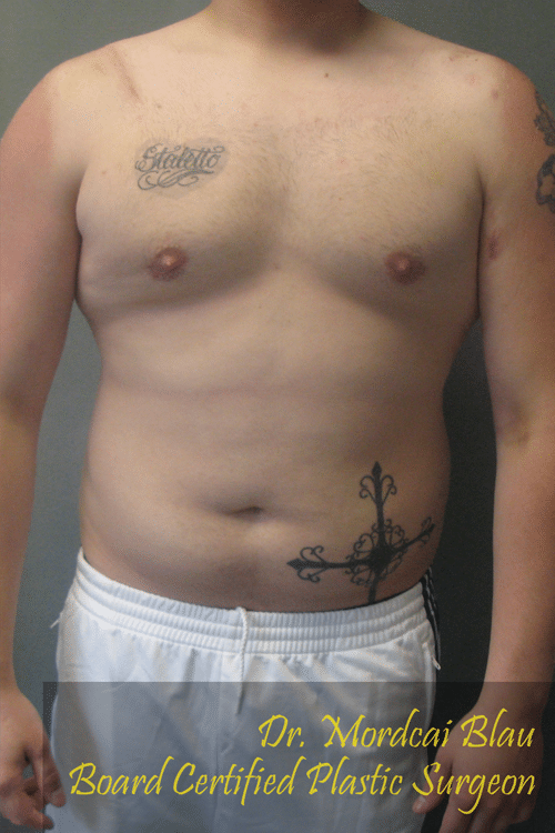 Adults (20-40) After Photo Adults (20-40)