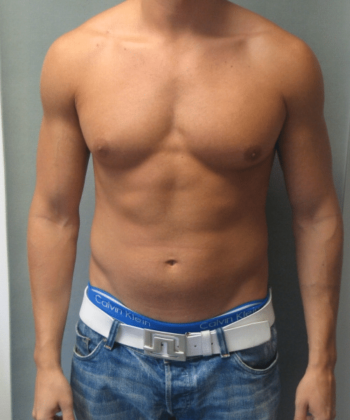 Adults (20-40) Before Photo Adults (20-40)