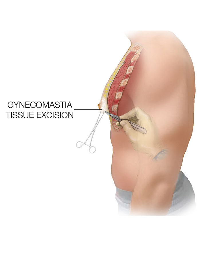 gynecomastia tissue excision