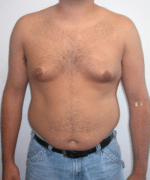 Pseudogynecomastia