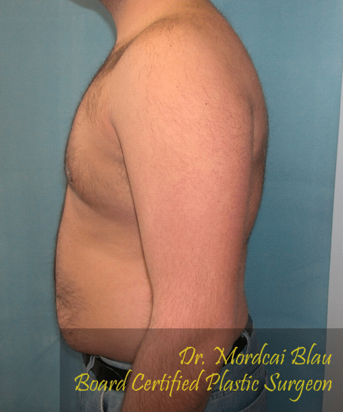 Pseudogynecomastia