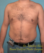 Pseudogynecomastia