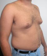 Pseudogynecomastia